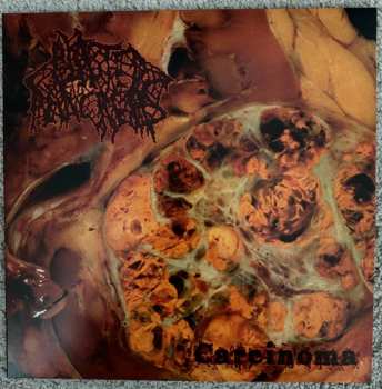 LP Blasted Pancreas: Carcinoma CLR | LTD 608528